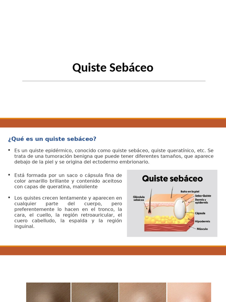 Quiste Sebáceo | PDF | Medicina CLINICA | Enfermedades y trastornos