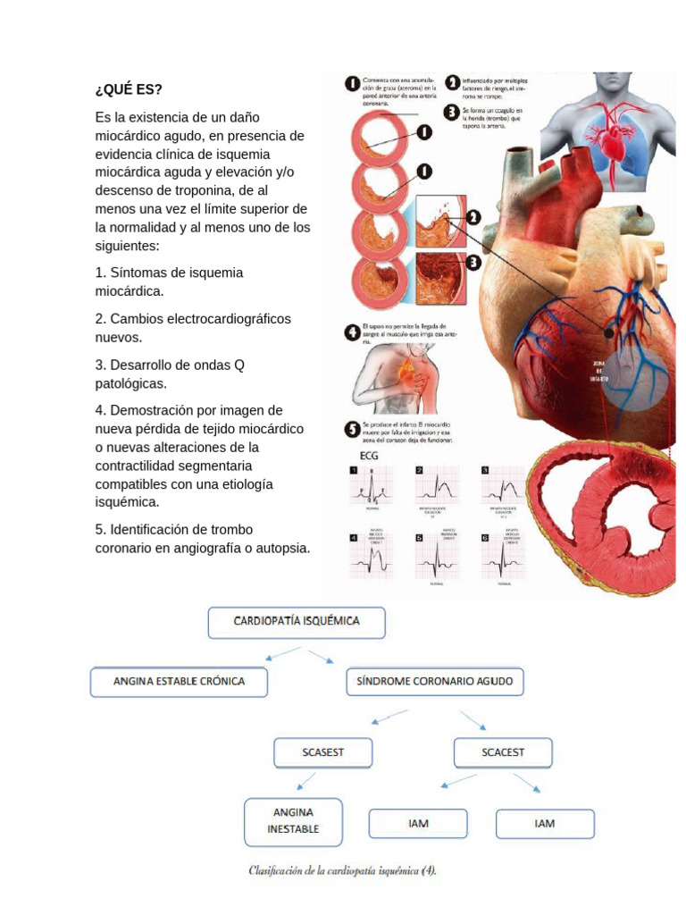 Clasificación y diagnóstico del infarto de miocardio | PDF | Infarto de ...