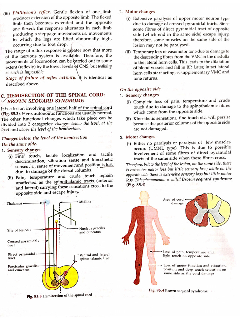 Understanding Brown-Sequard Syndrome | PDF | Somatosensory System ...
