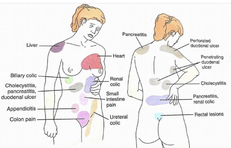 Reffered Pain Regions | PDF