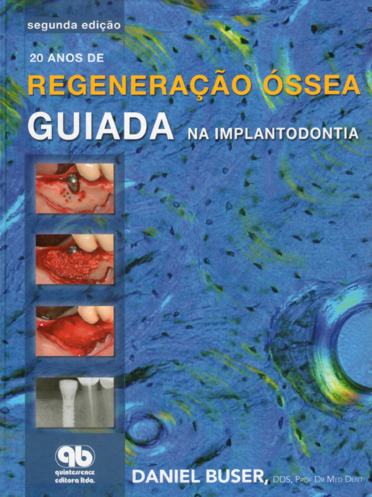 20 Anos de Regeneração Óssea Guiada Na Implantodontia - Daniel Buser ...