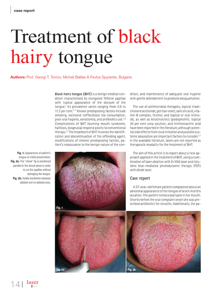 laser-treatment-for-black-hairy-tongue-pdf-medical-specialties