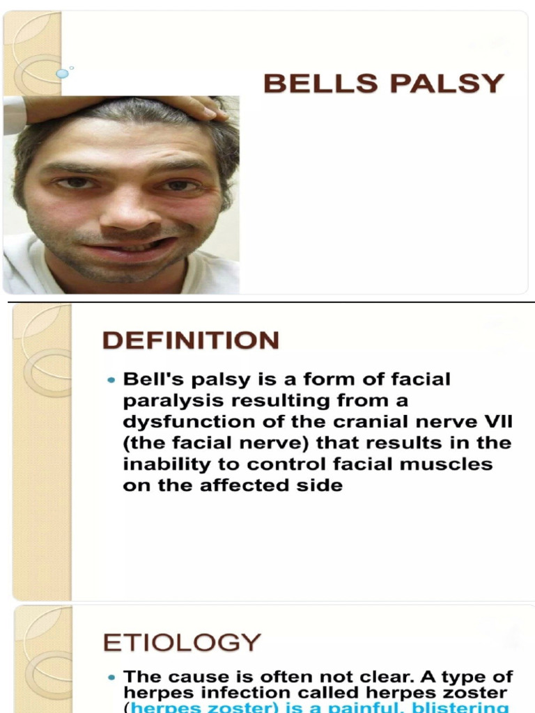 Bells Palsy | PDF