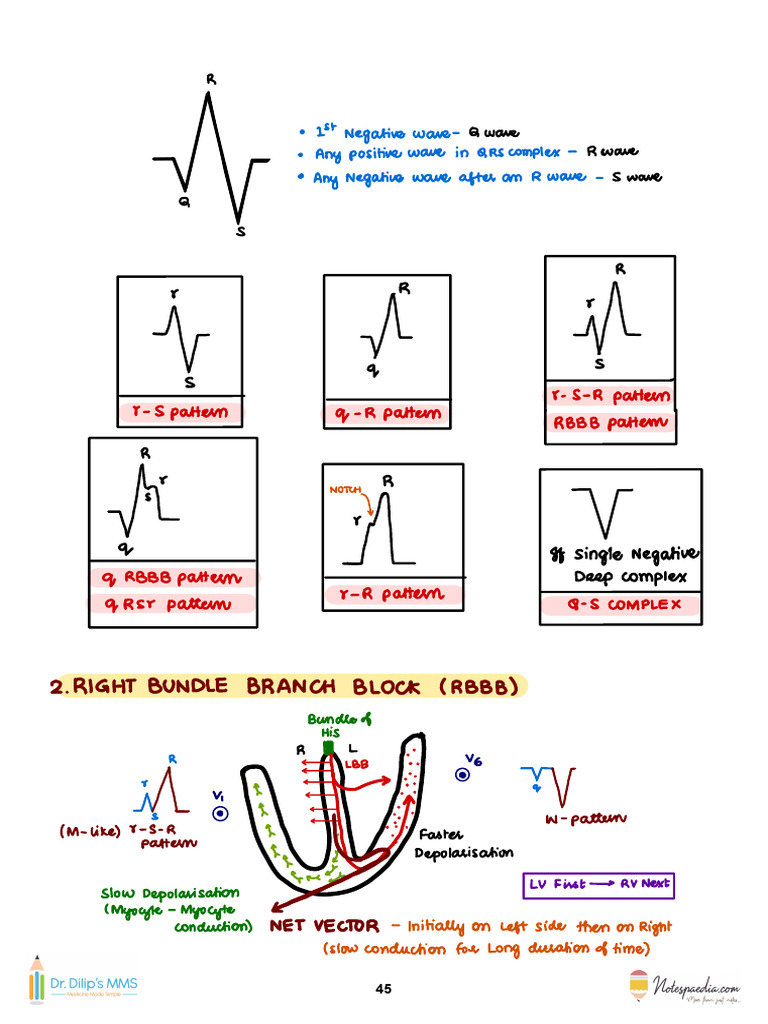 Right Bundle Branch Block Overview | PDF | Ventricle (Heart) | Cardiology