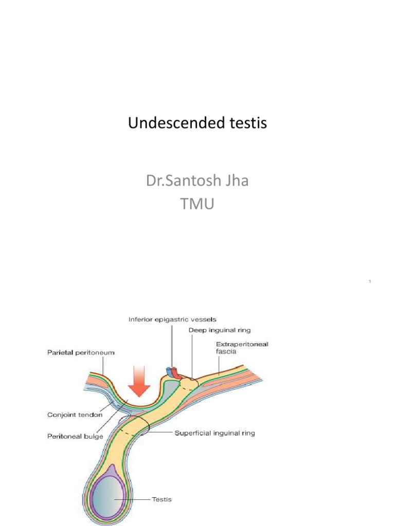 Undescended Testis DR Santosh Jha TMU PDF Testicle Reproductive System