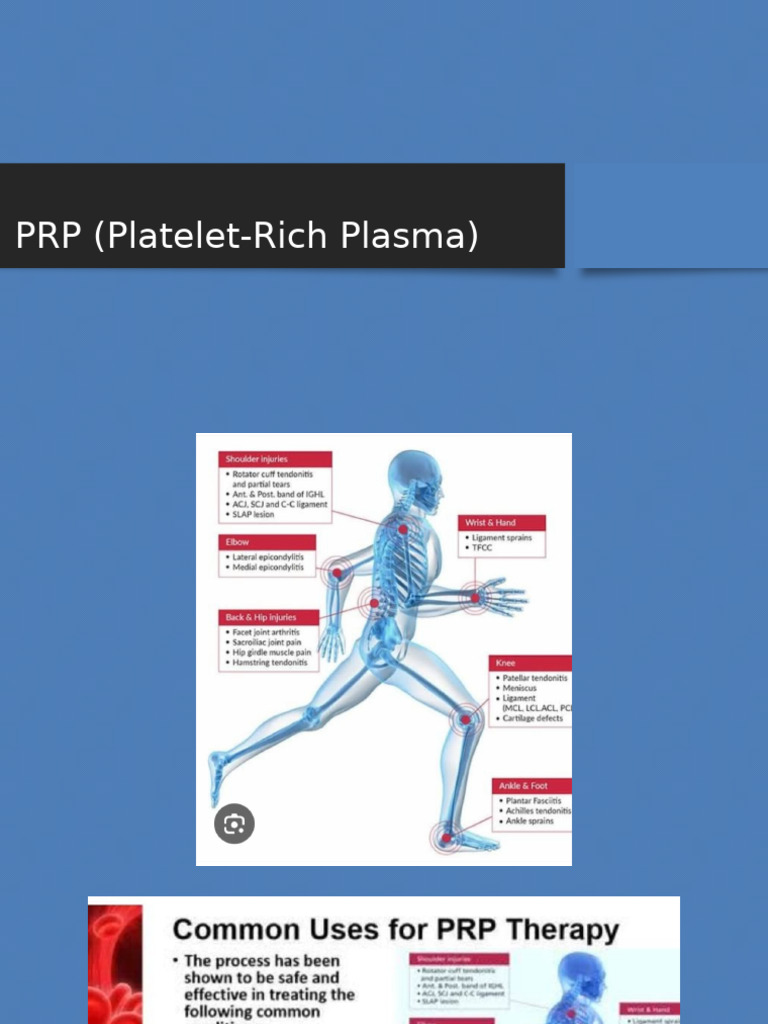 PRP - Platelet Rich Plasma | PDF