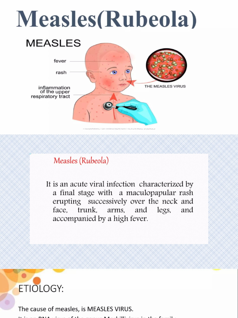Measles | PDF