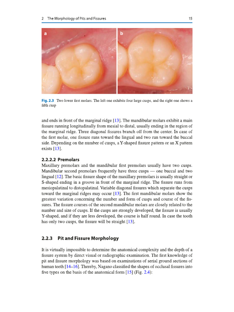 Pits and Fissure Dr. Ban | PDF
