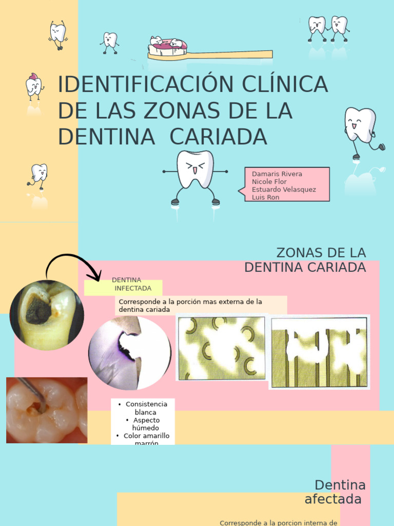 Identificación Clínica de Dentina Cariada | PDF