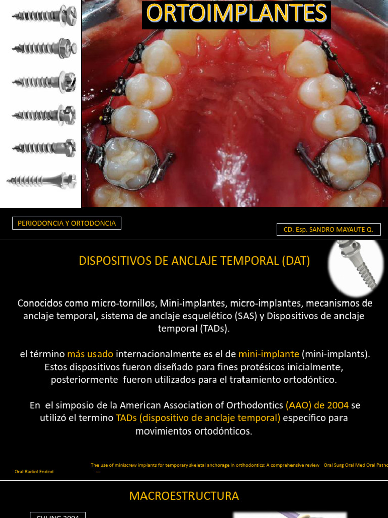 Miniimplantes en Ortodoncia: Guía Completa | PDF | Hueso