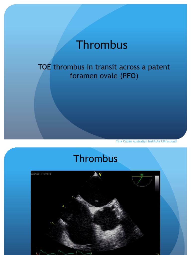 TOE Thrombus Across PFO Explained | PDF