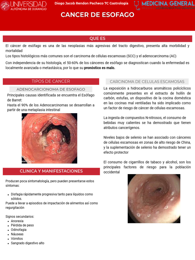 Cancer de Esofago | PDF | Cáncer | Cáncer de esófago