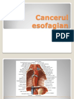 Cancerul esofagian