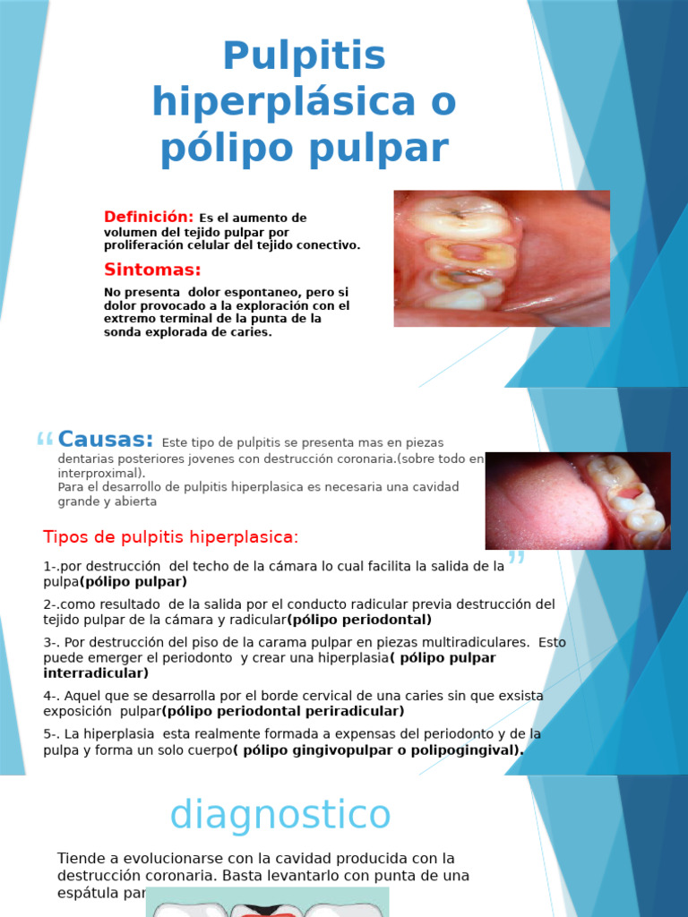 Pulpitis Hiperplásica y Pólipo Pulpar | PDF