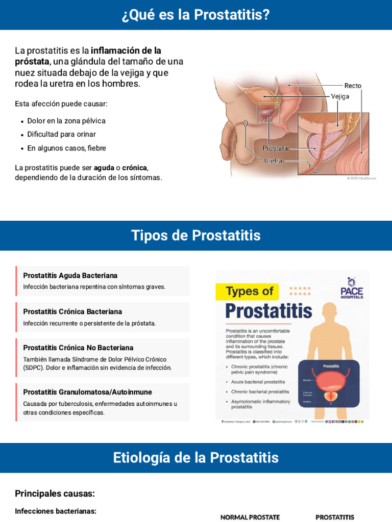 Prostatitis: Tipos, Causas y Tratamientos | PDF | Inflamación | Próstata