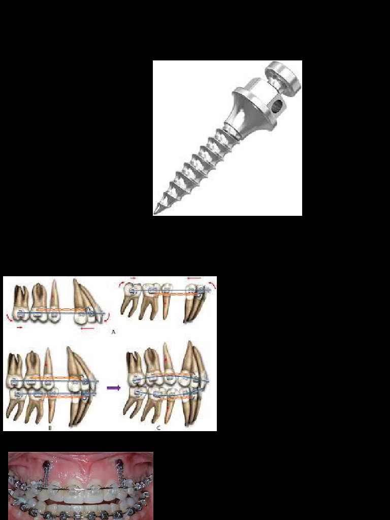Understanding Temporary Anchorage Devices | PDF | Orthodontics | Dental ...