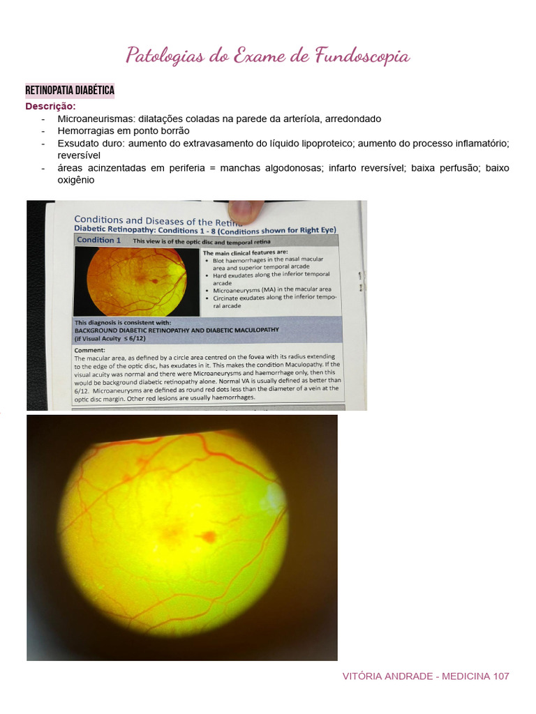 Patologias Comuns em Fundoscopia | PDF