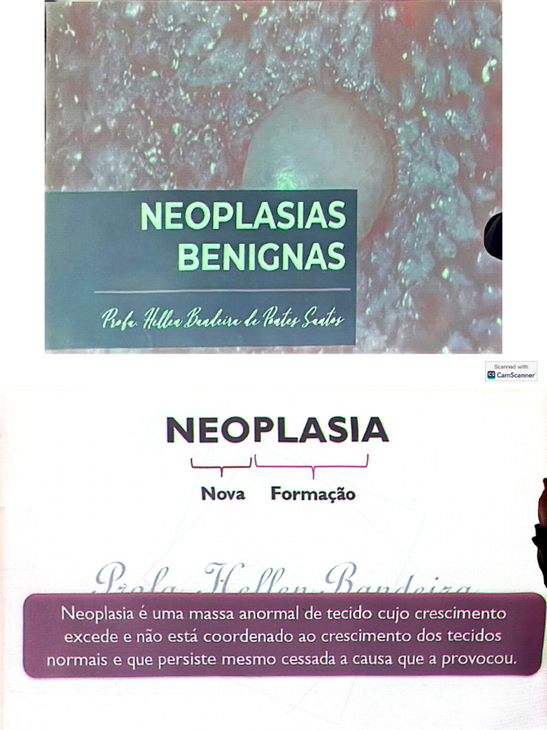 Neoplasias Benignas | PDF