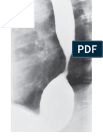 6.5 Esophageal Strictures