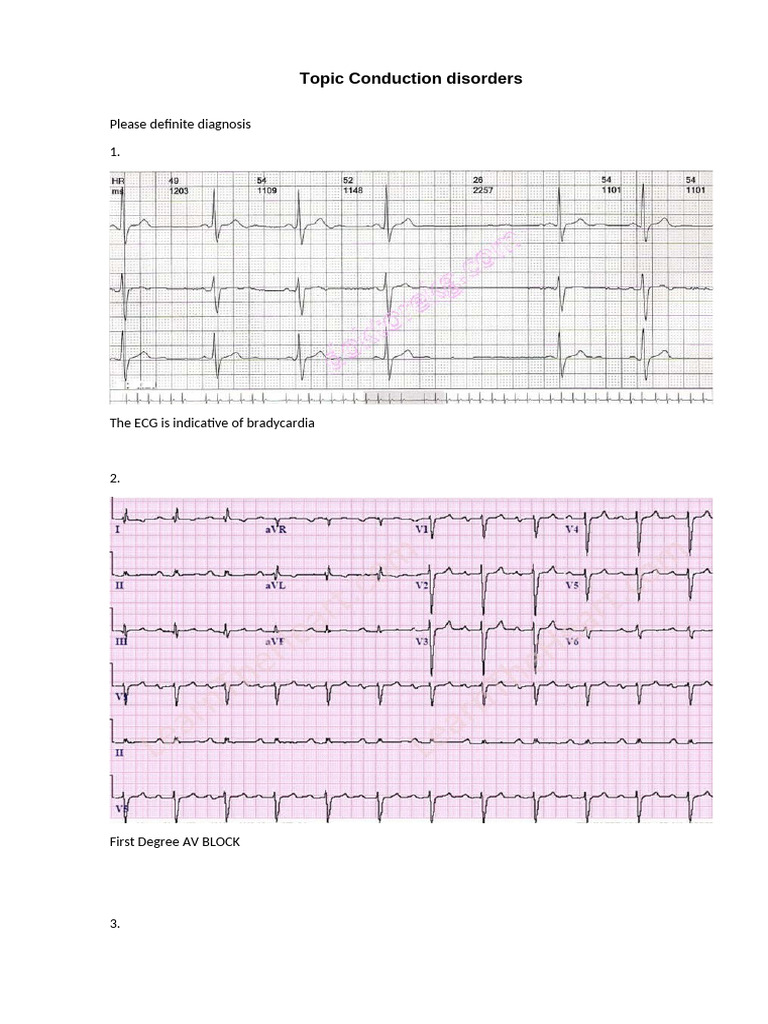 Conduction Disorders and ECG Diagnosis | PDF
