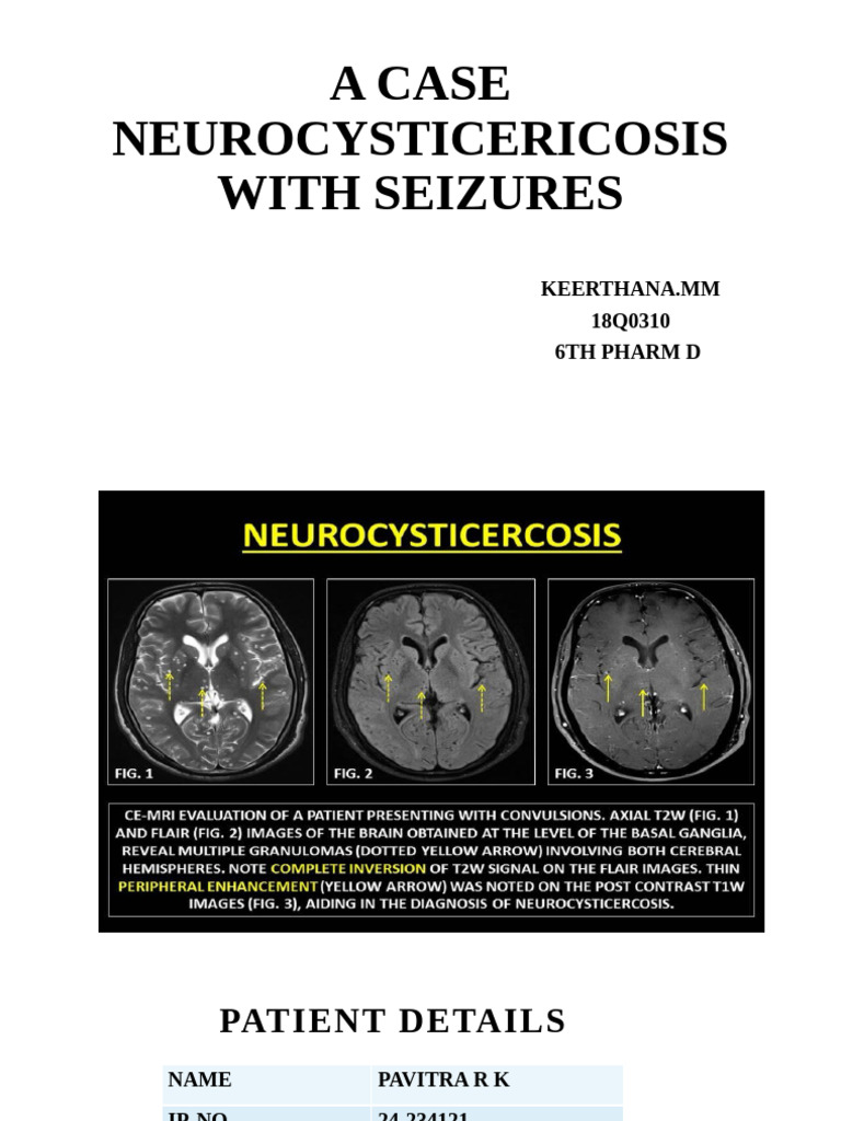 Neurocysticercosis Case Study with Seizures | PDF | Human Diseases And ...