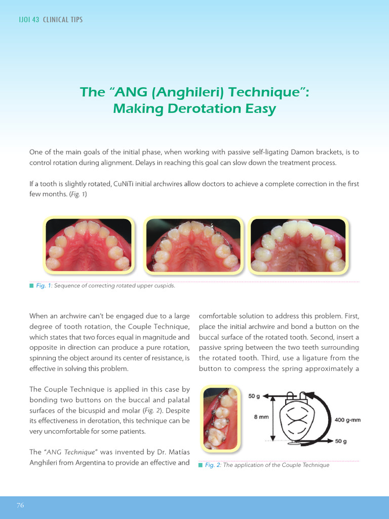 ANG Technique for Tooth Derotation | PDF