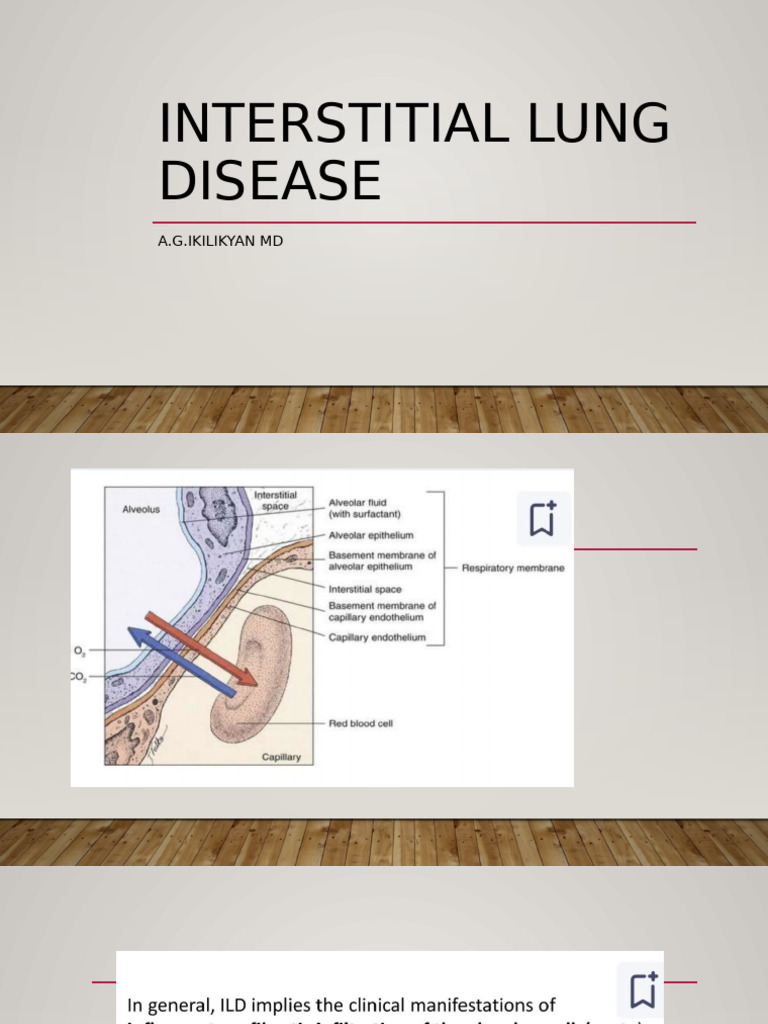 Understanding Interstitial Lung Disease | PDF | Respiratory Diseases ...