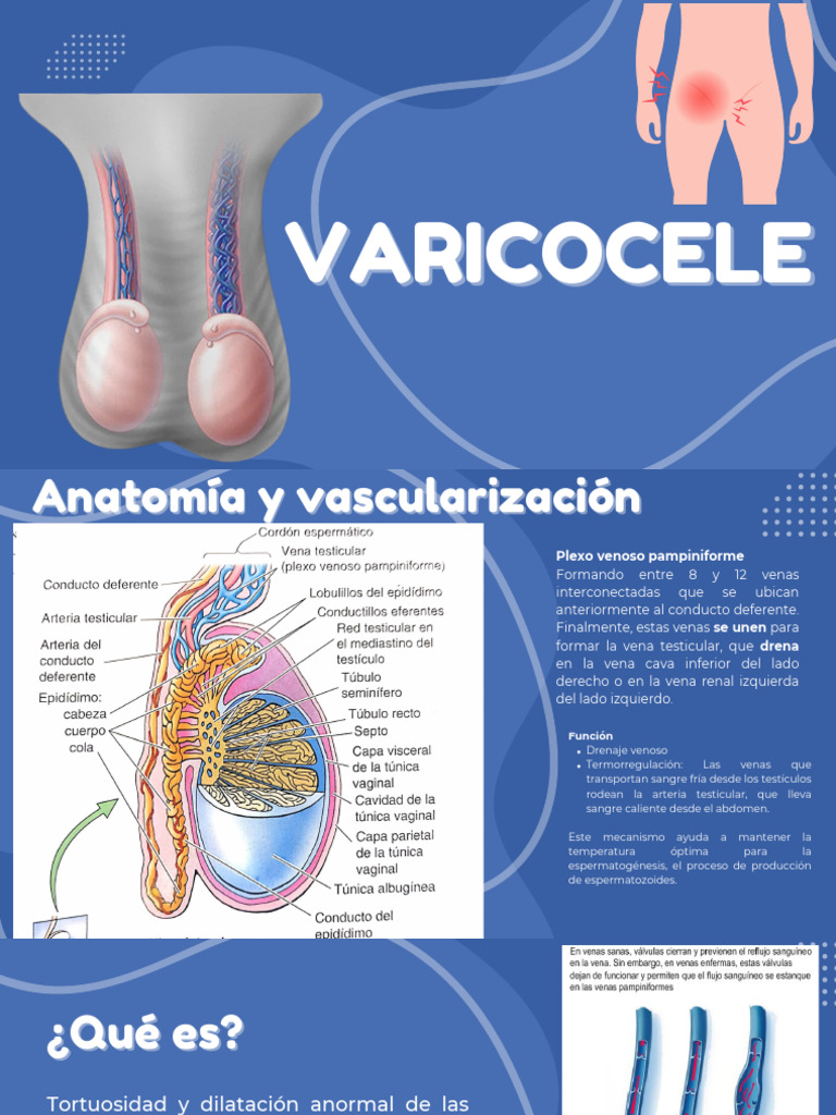 Varicocele: Anatomía y Tratamiento | PDF | Medicina CLINICA ...