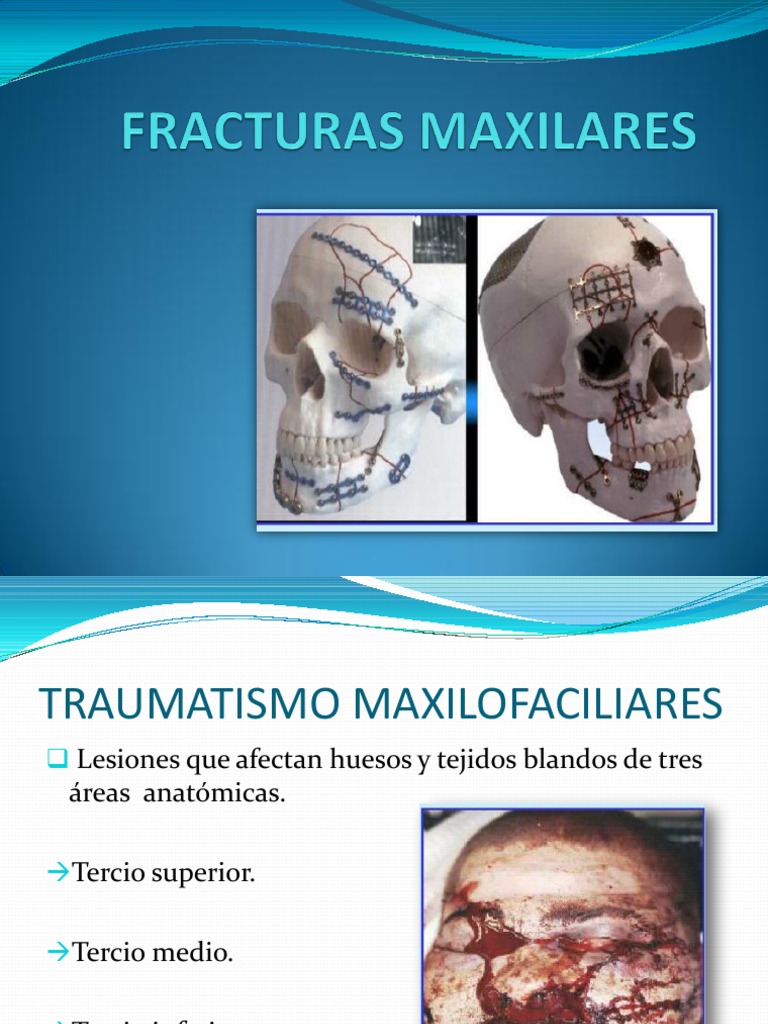 Fracturas del Maxilar Superior: Tipos y Tratamiento | PDF | Ciencia y ...