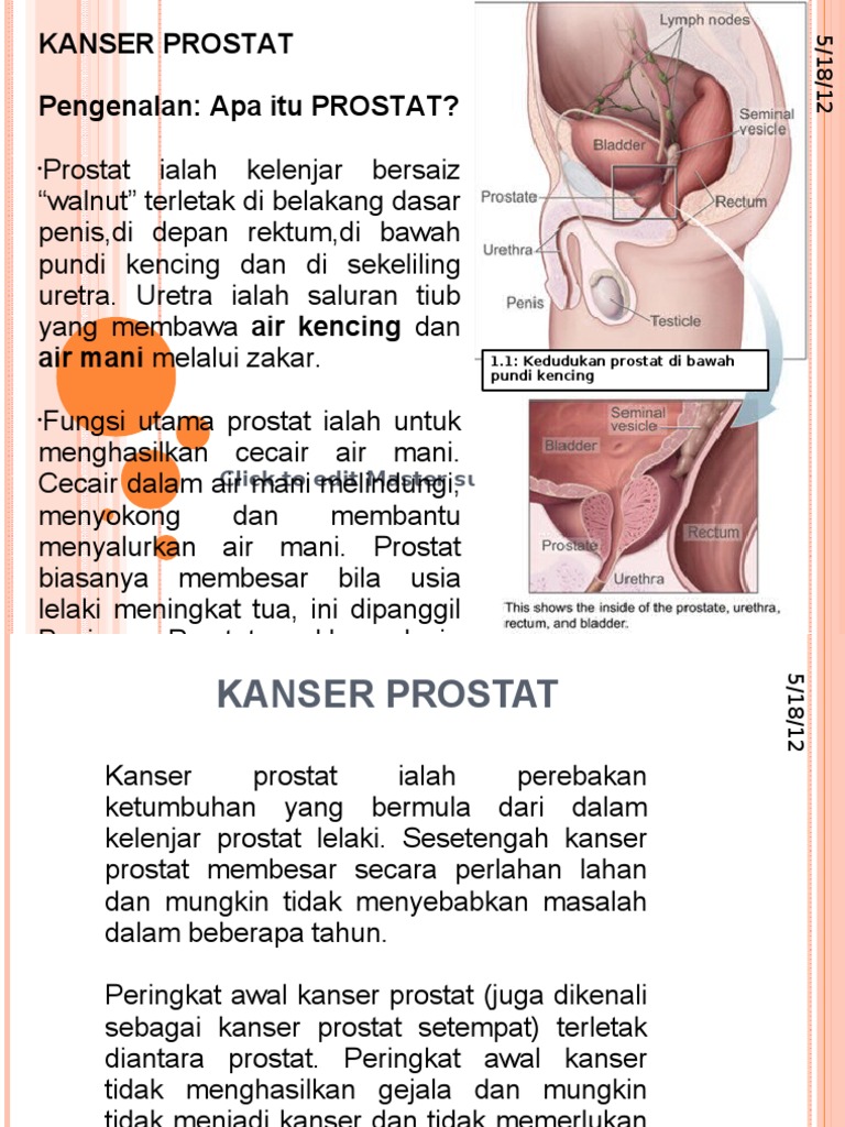 Kanser Prostat