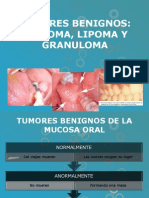 Lipoma, Granuloma, Fibroma