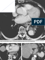 CT and MR of Stomach