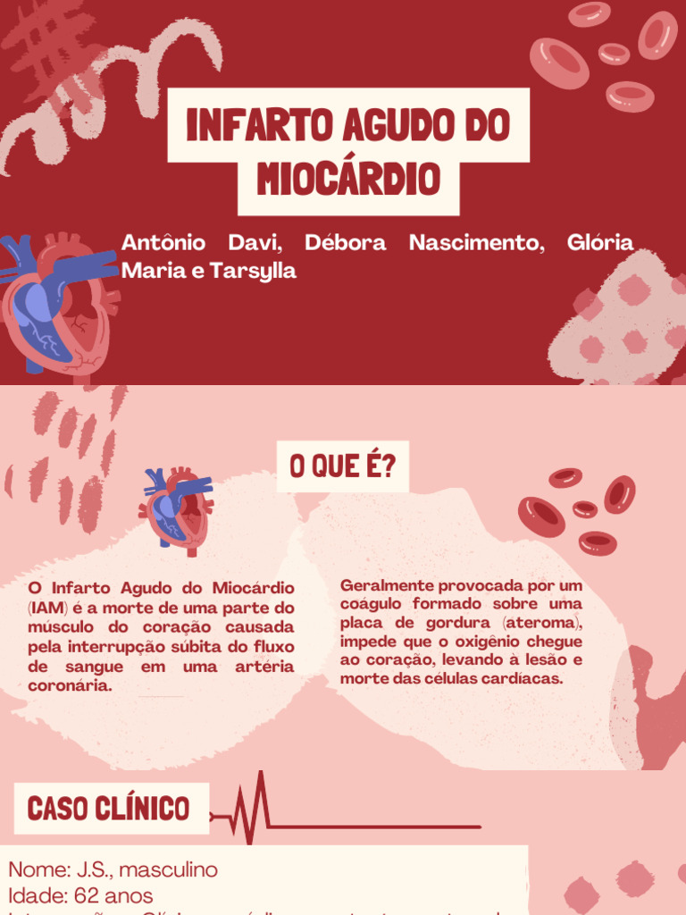 Infarto Agudo do Miocárdio: Diagnóstico e Tratamento | PDF | Infarto do ...