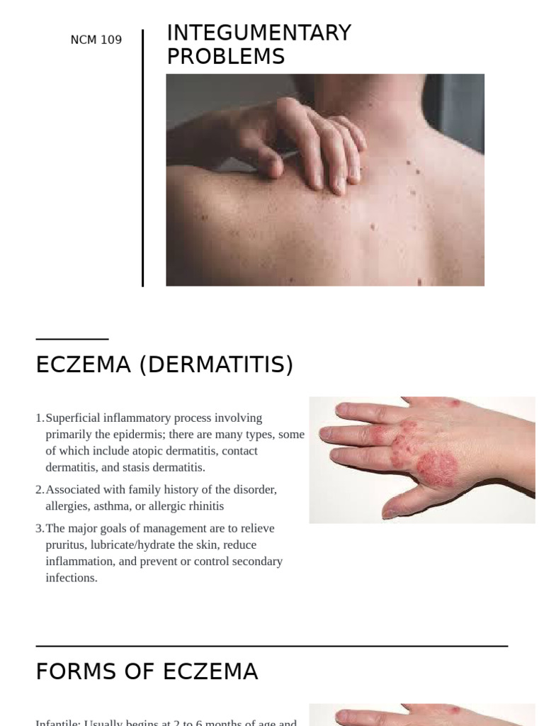 Eczema and Skin Infection Management | PDF | Dermatitis | Allergy