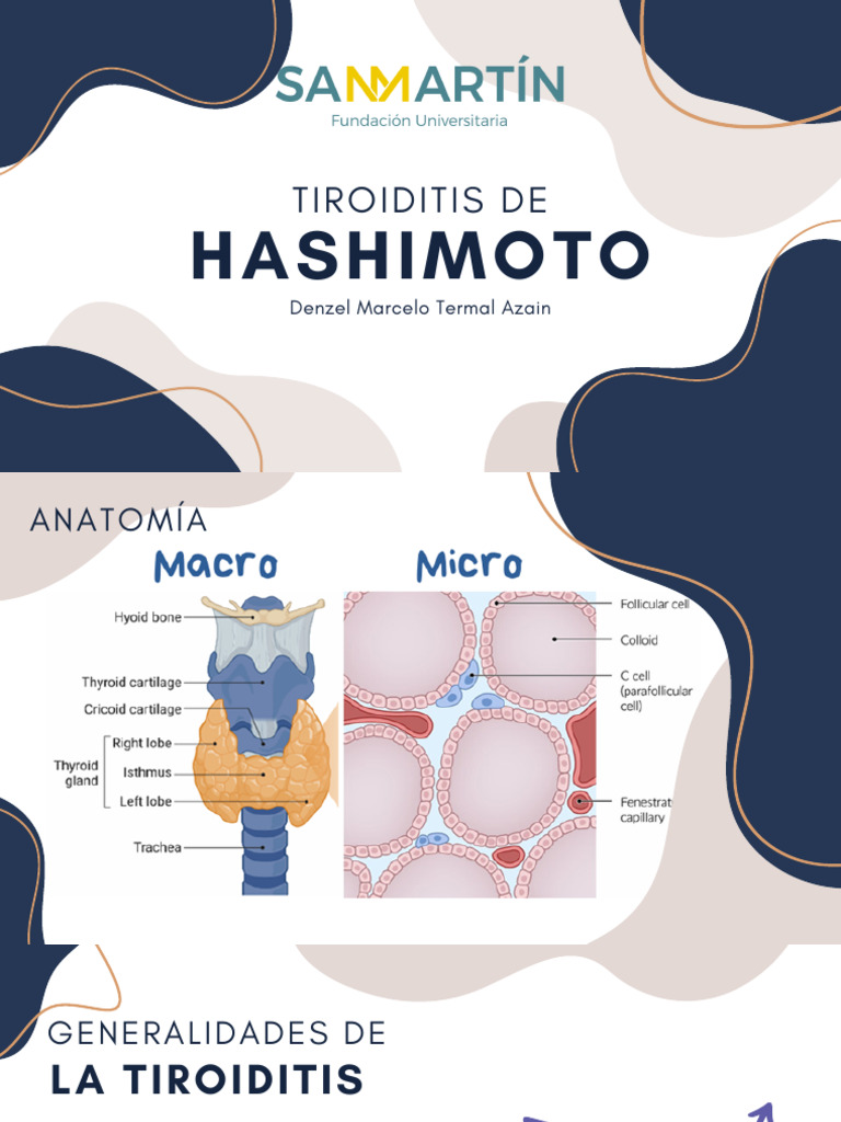 Tiroiditis de Hashimoto: Diagnóstico y Tratamiento | PDF