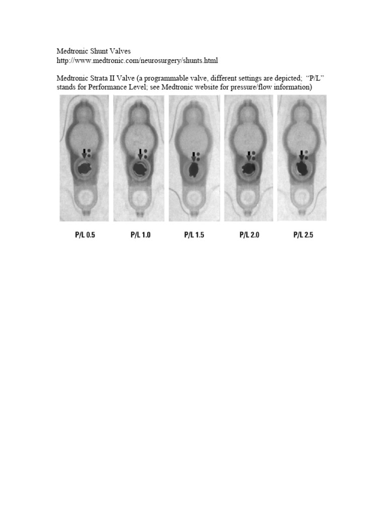 Medtronic Programmable Shunt Overview | PDF