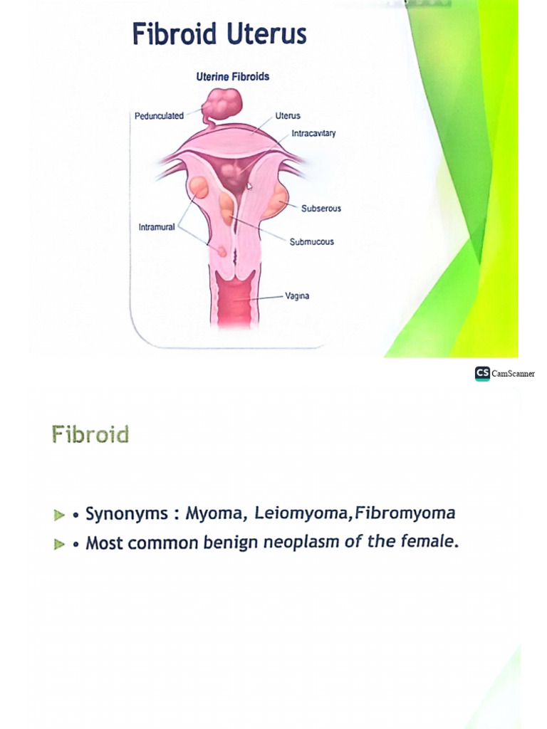 Fibroid Uterus | PDF