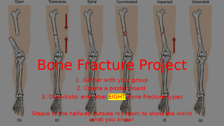 Types of Bone Fractures Illustrated | PDF