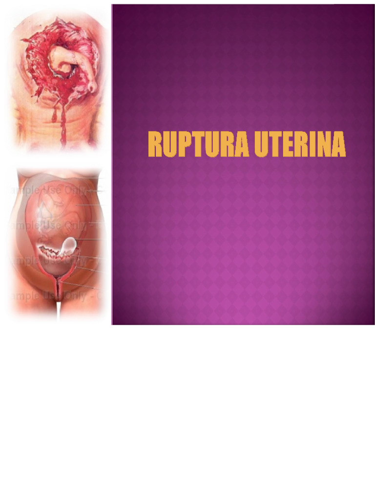Rupture utérine : causes et conséquences | PDF | Utérus | Accouchement
