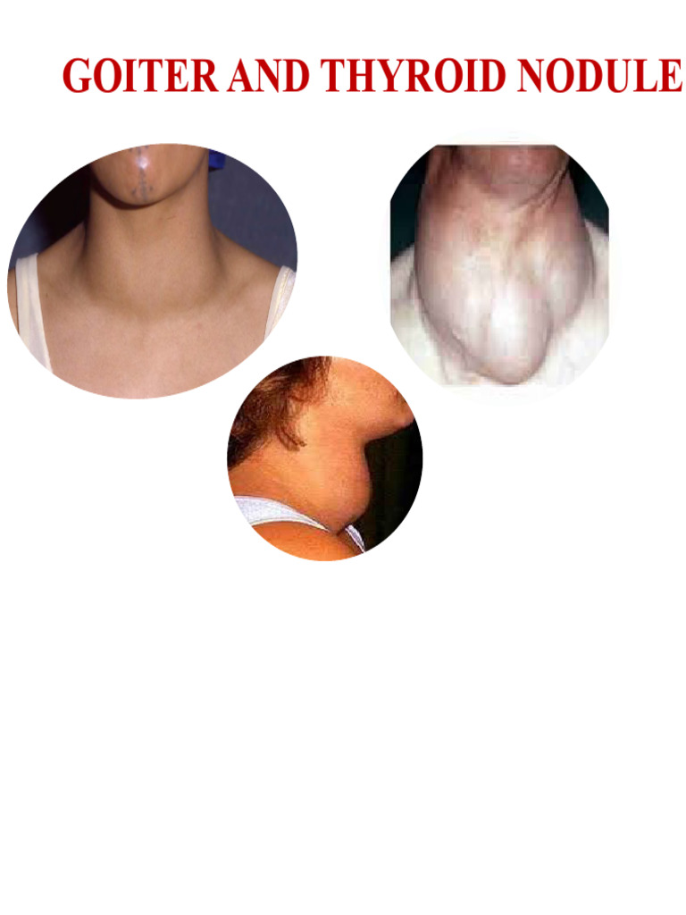 Goiter and Thyroid Nodules Overview | PDF | Thyroid | Hyperthyroidism