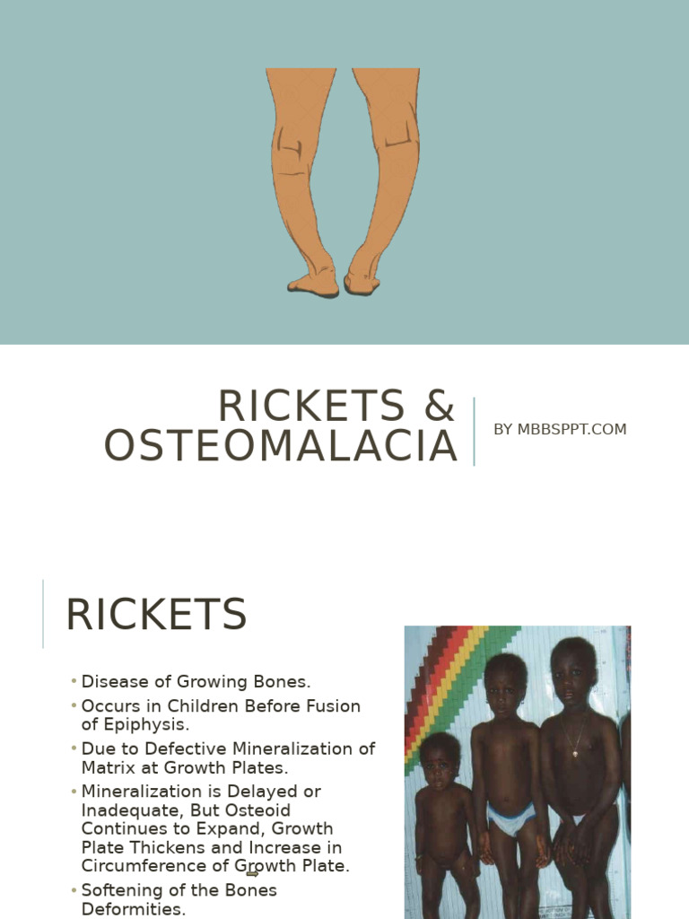 Rickets and Osteomalacia | PDF | Vitamin D | Diseases And Disorders