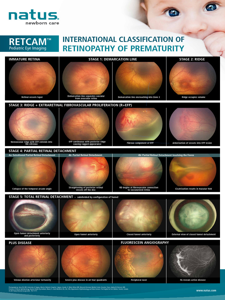 Retinopathy of Prematurity Classification | PDF | Retina | Eye