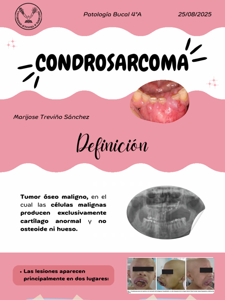 Condrosarcoma: Diagnóstico y Tratamiento | PDF | Neoplasias | Cáncer