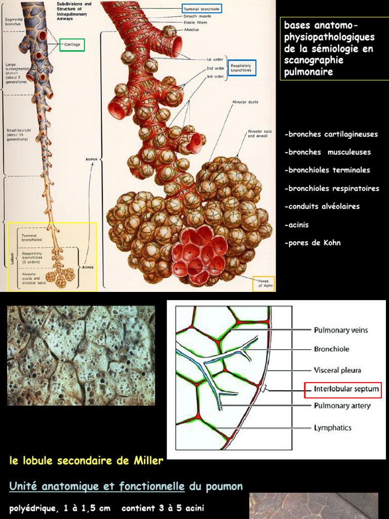 Anatomie et pathologies pulmonaires en CT | PDF | Bronchopneumopathie ...