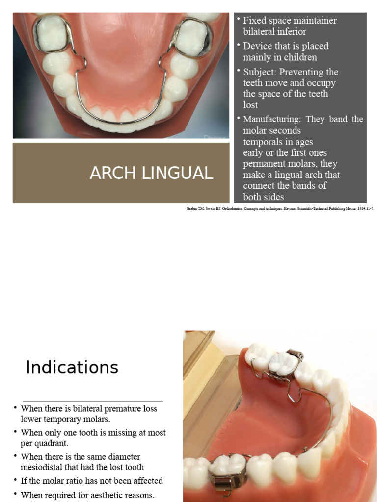 Lingual Arch as Space Maintainer | PDF | Orthodontics | Dentistry