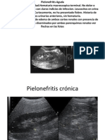 Pielonefritis Aguda