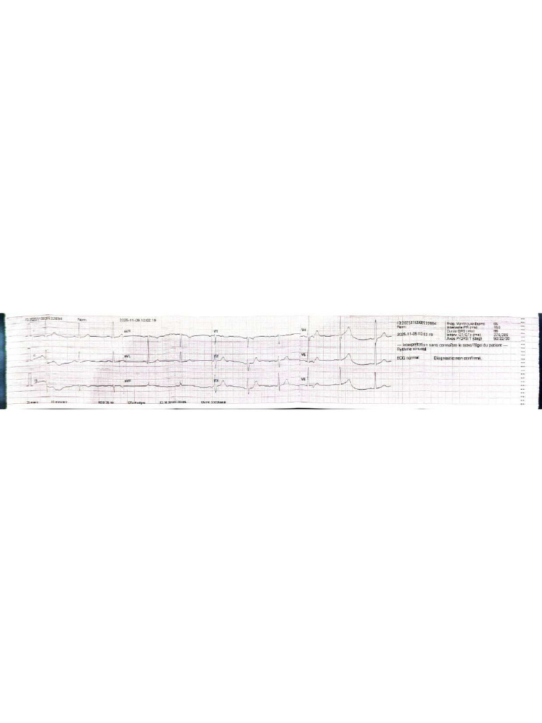 Ecg | PDF