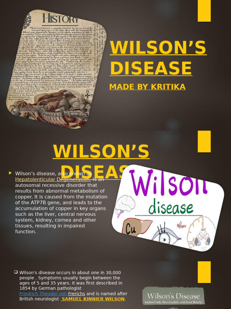Wilsons Disease Completed With Images | PDF | Hepatitis | Medicine
