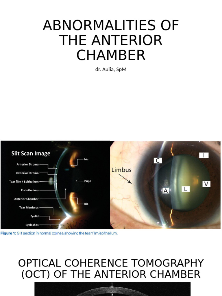 Abnormalities of The Anterior Chamber | PDF