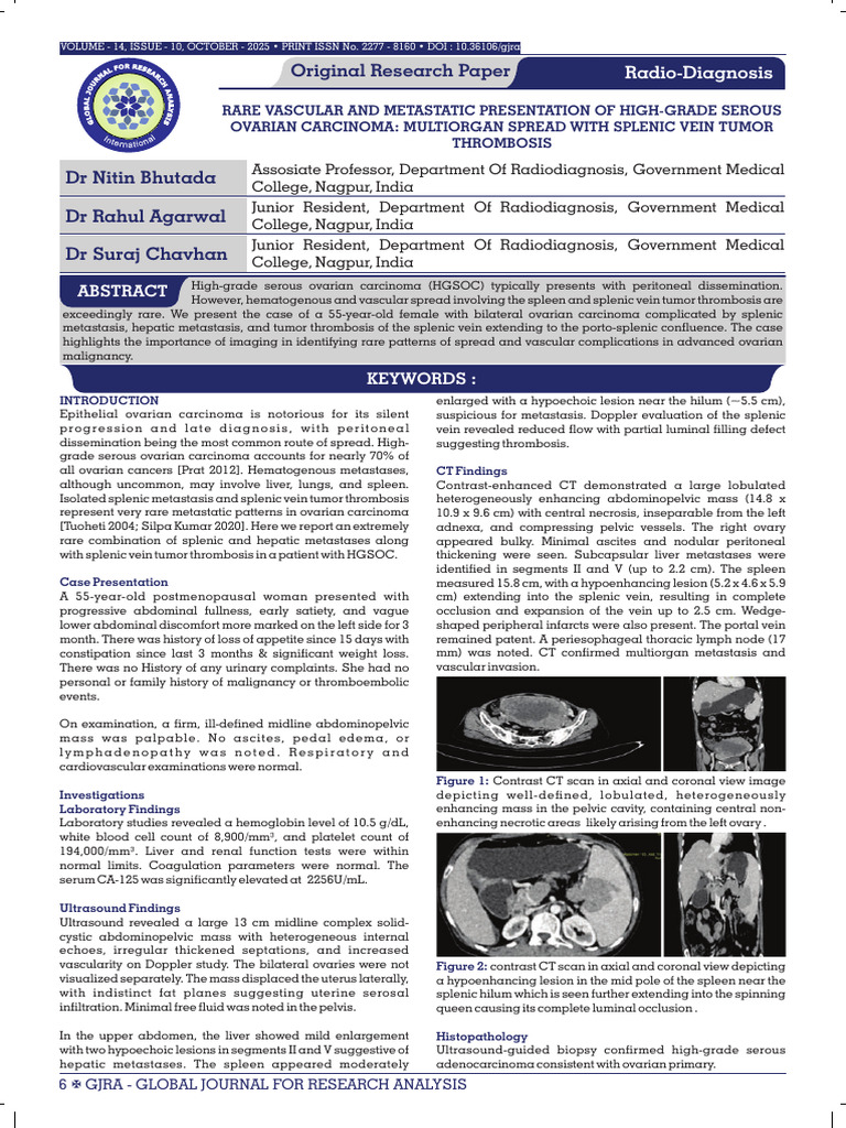Original Research Paper | PDF | Metastasis | Ovarian Cancer